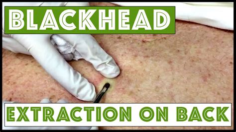 Last Updated January 13, 2021, 12:00 PM. . Huge back blackhead removal videos